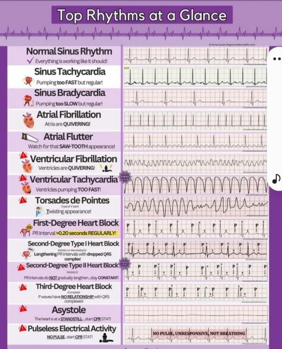 For MBBS and NEET PG students, all important Cardiac Arrhythmias at a glance.
#Cardiology #MBBS #NEETPG 
#MedX #MedEd 
@IhabFathiSulima @DrAkhilRaghavan @DrSanjay277 @drrhaul