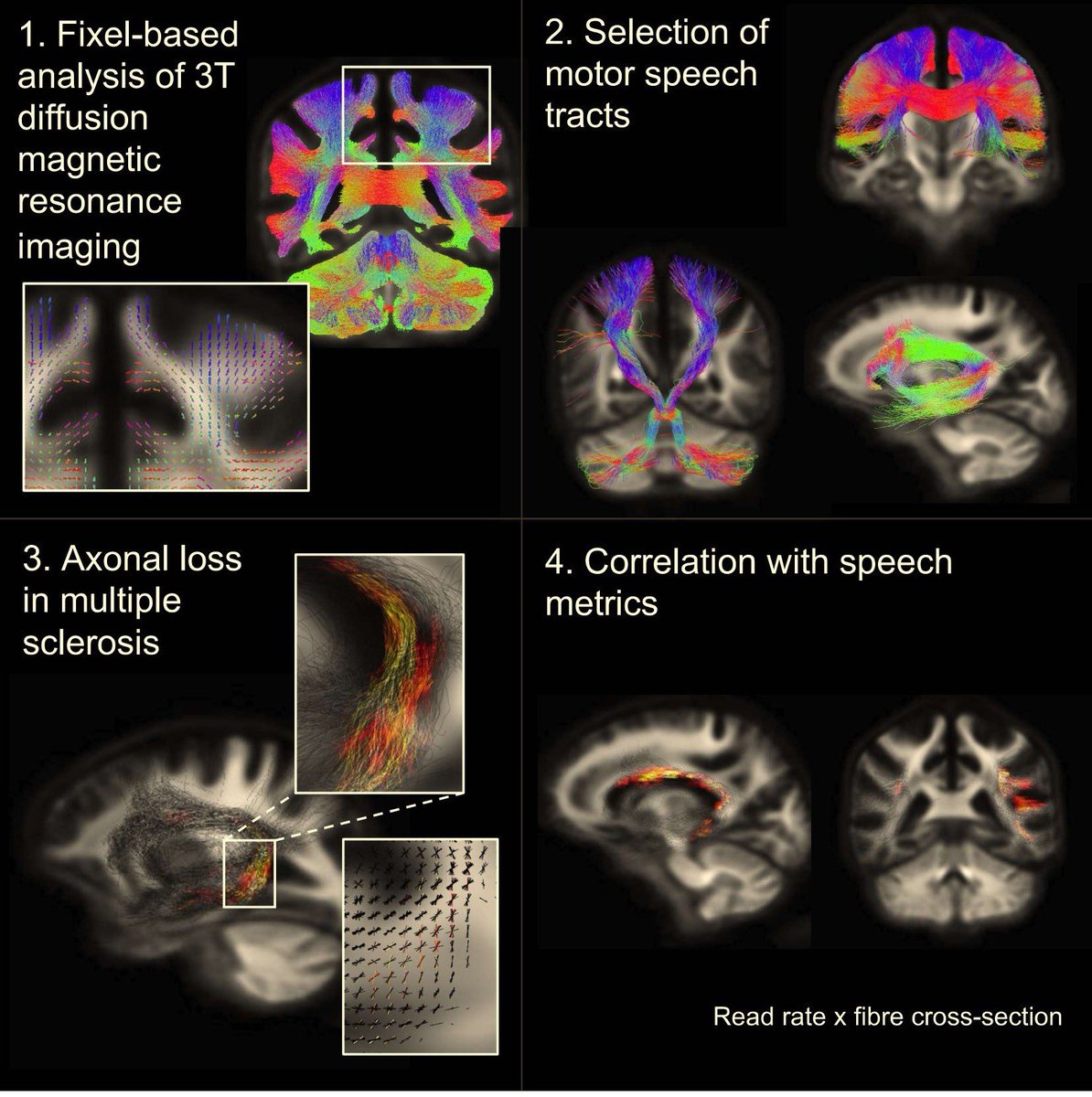 Ever wonder what microstructural damage in #multiplesclerosis is linked to symptoms of #dysarthria? Read my new #dMRI paper to find out!  
doi.org/10.1093/brainc…