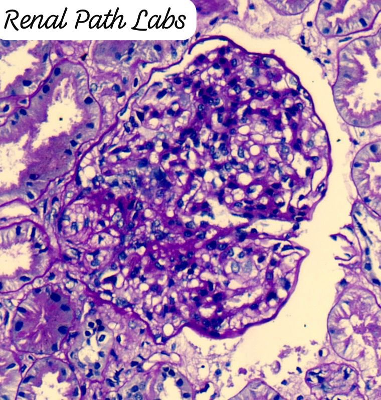 RenalPathLabs's tweet photo. What will you like to label these lesions?? Same case.
#RenalPathCases #RenalPathology #AskRenal #AskRenalPath #RenalPath #PoojaMaheshwari #NephTwitter #PathTwitter #RenalPathLabs https://t.co/LGJrJngScE