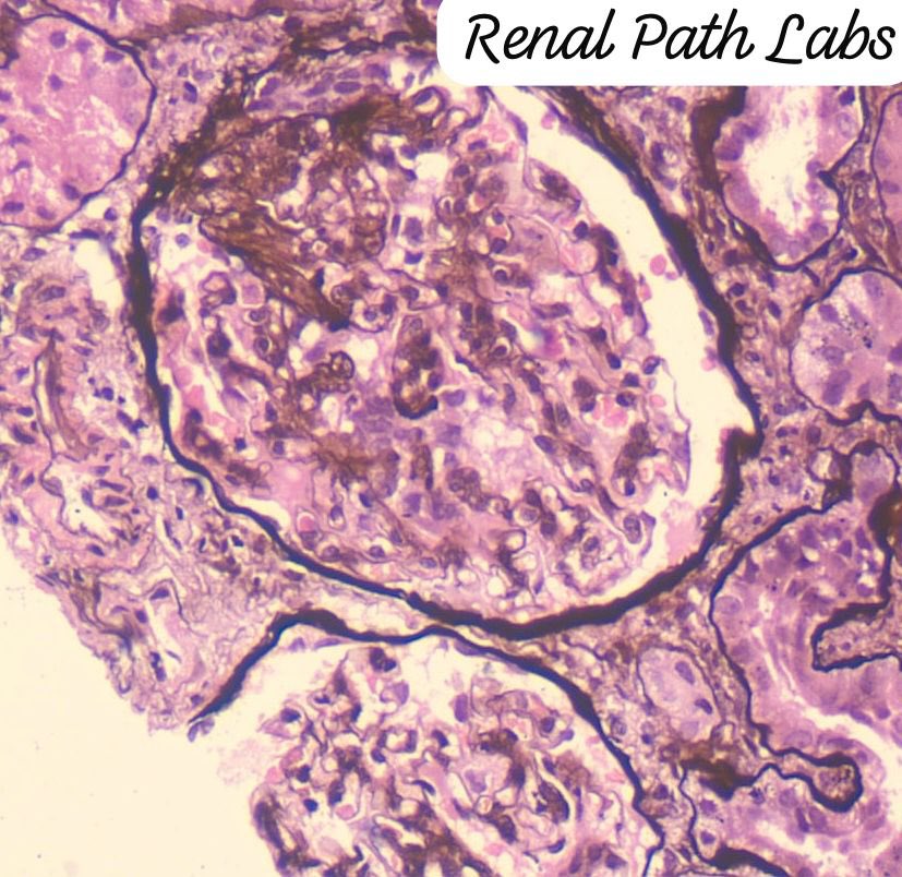 What will you like to label these lesions?? Same case.

#RenalPathCases #RenalPathology #AskRenal #AskRenalPath #RenalPath #PoojaMaheshwari #NephTwitter #PathTwitter #RenalPathLabs