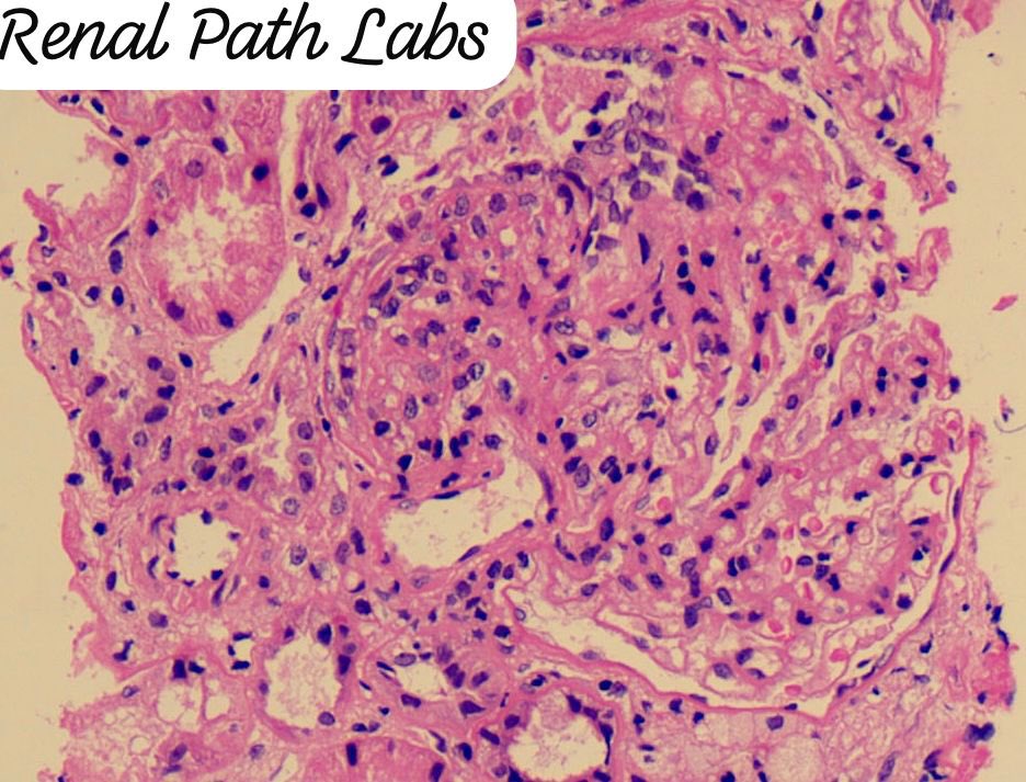 RenalPathLabs's tweet photo. What will you like to label these lesions?? Same case.
#RenalPathCases #RenalPathology #AskRenal #AskRenalPath #RenalPath #PoojaMaheshwari #NephTwitter #PathTwitter #RenalPathLabs https://t.co/LGJrJngScE