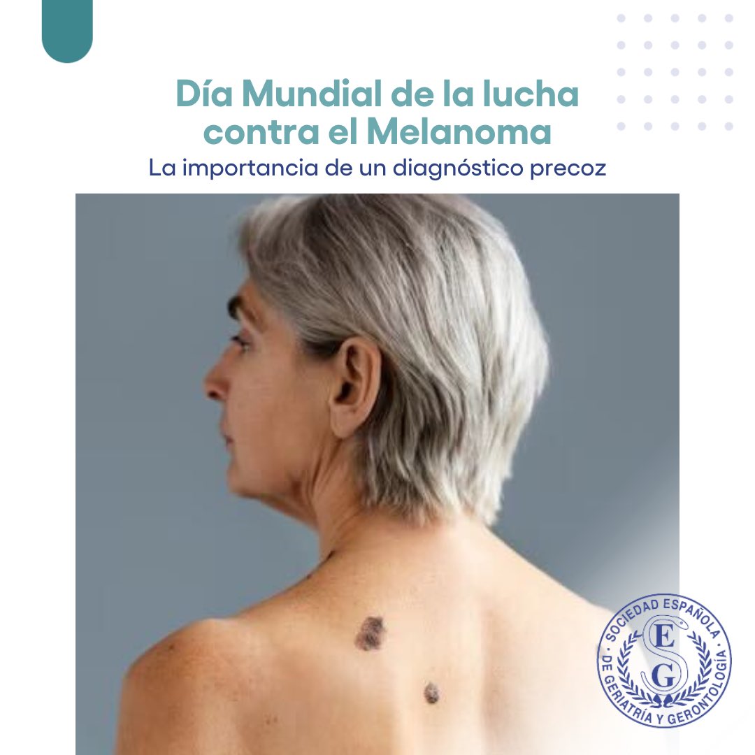 SEGG (@seggeriatria) on Twitter photo 🗓️ 23 de Mayo: Día Mundial de la Lucha Contra el Melanoma
Casi la mitad de los casos de melanoma afectan a personas mayores de 65 años. El diagnóstico temprano es clave para tratar el melanoma con éxito, pero a menudo las lesiones pasan desapercibidas. 🗓️ 23 de Mayo: Día Mundial de la Lucha Contra el Melanoma
Casi la mitad de los casos de melanoma afectan a personas mayores de 65 años. El diagnóstico temprano es clave para tratar el melanoma con éxito, pero a menudo las lesiones pasan desapercibidas.