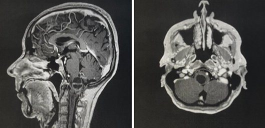 AmuGranada's tweet photo. Desafíos de neurocirugía: Manejo integral de un ependimoma en la unión bulbomedular.

https://t.co/3jUV021svm https://t.co/Z40rSMEoFe