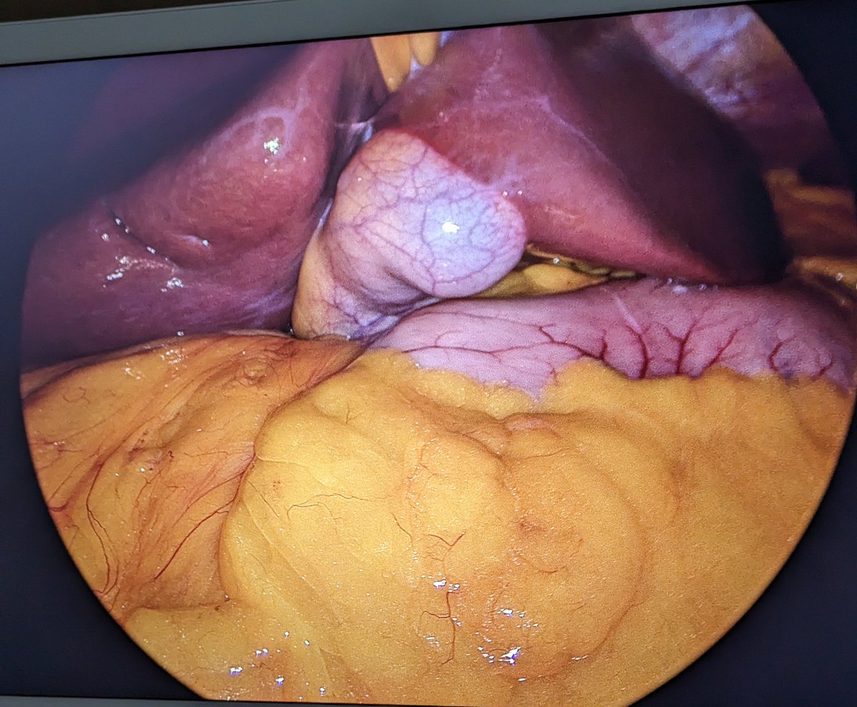 Interesting anatomical variation during lap chole, first time I see it

Thoughts on approach?