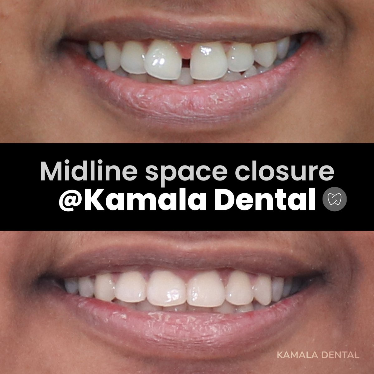 kamala_dental's tweet image. Midline Space Closure at Kamala Dental
@KamalaDental 
+91 90720 66001, 95260 66001, 0471 2338410/20
info@kamaladental.com
kamaladental.com
Sree Mulam Club Jn., Vazhuthacaud, Thiruvananthapuram, Kerala, India
#toothgap
#smilemakeover
#bestdentalclinic
#orthodontictreatment
