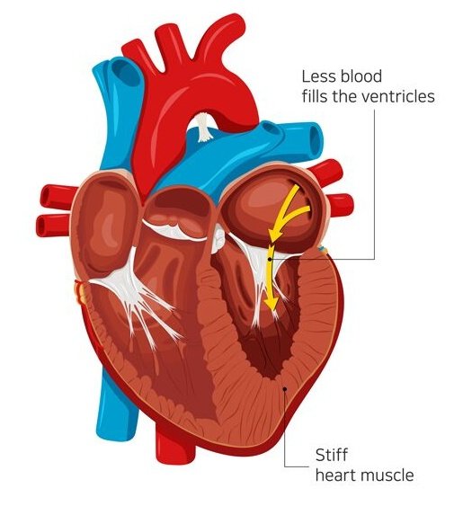 📙𝘾𝙇𝙄𝙉𝙄𝘾𝘼𝙇 𝙌𝙐𝙄𝙕:-

Which antifungal should be avoided in patients with ventricular dysfunction ❓❓

A) Terbinafine 
B) Itraconazole
C) Micafungin
D) Posacinazole

#medx
#medEd