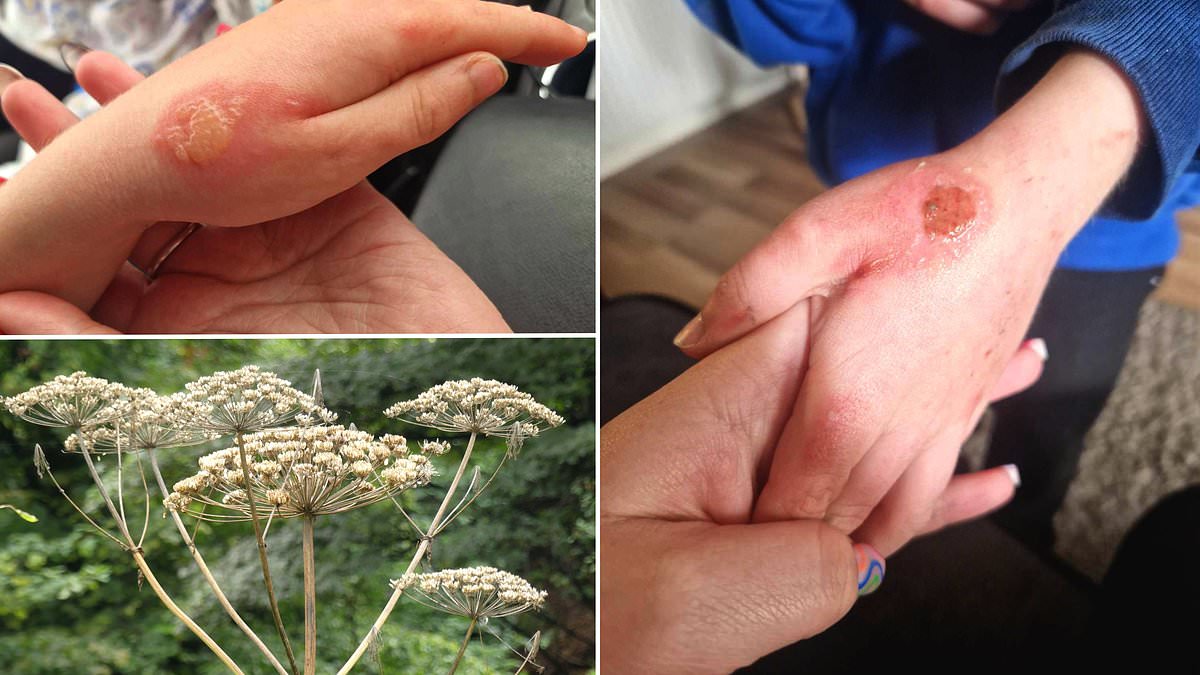 Britain's 'most dangerous plant' strikes in County Down: Schoolboy, 8, is left with painful blisters over his hands and arms after accidentally brushing past giant hogweed trib.al/tGFcUJc