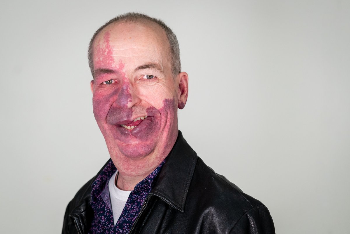 “My birthmark doesn’t define me – my personality, skills and interests mean so much more than my appearance.” Our ambassador Phil found the confidence to be himself after using Changing Faces’ counselling service: ow.ly/yqQz50ROqLS