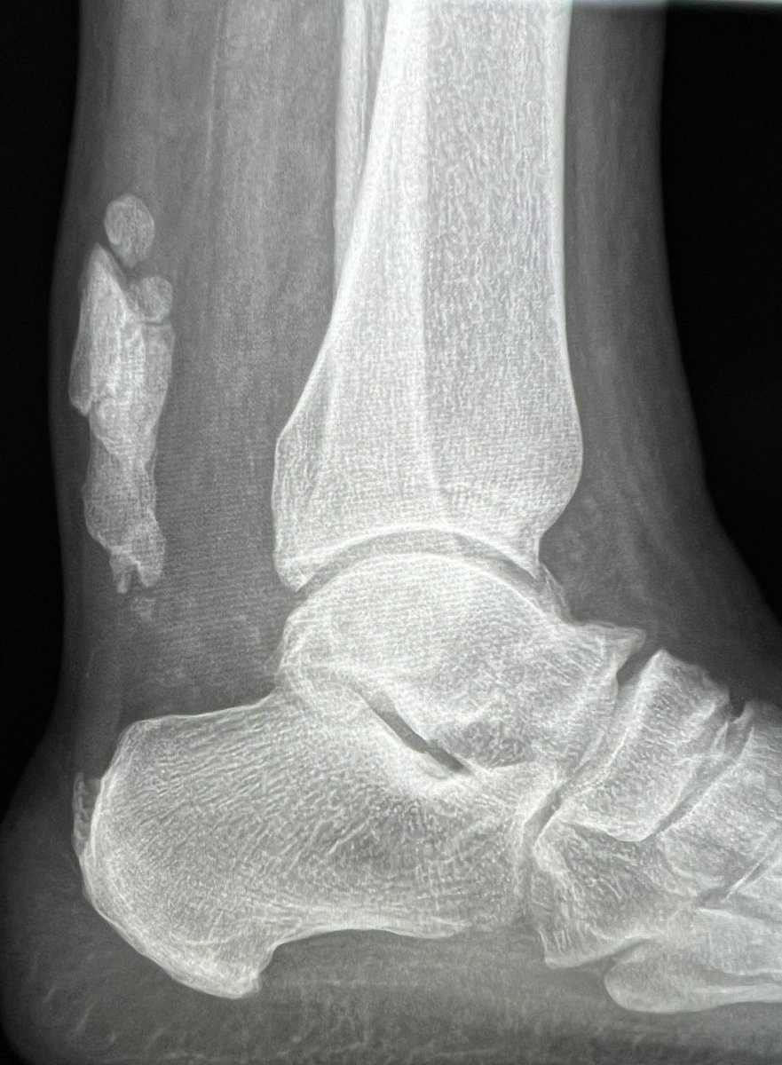 Findings in hondfoot ? 

#radres #radtwitter