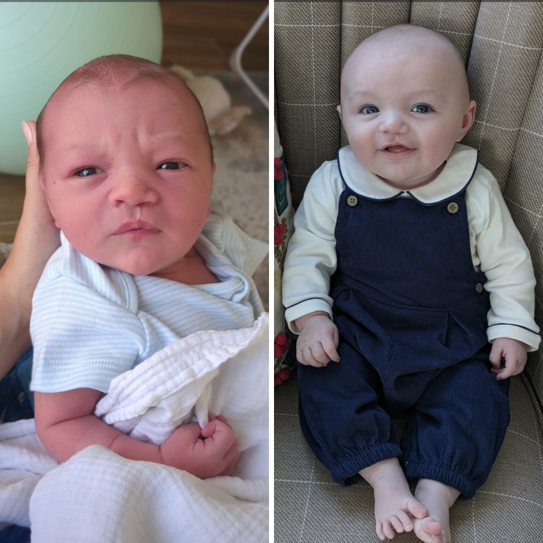 Thank you for sharing these adorable photos with us Aileen.💙 Aileen said, “Baby Patrick was born with a Microcleft lip in 2023. It was so minor it would not have been able to be picked up on any of his scans. I wanted to show what his cleft looks like four months post surgery'