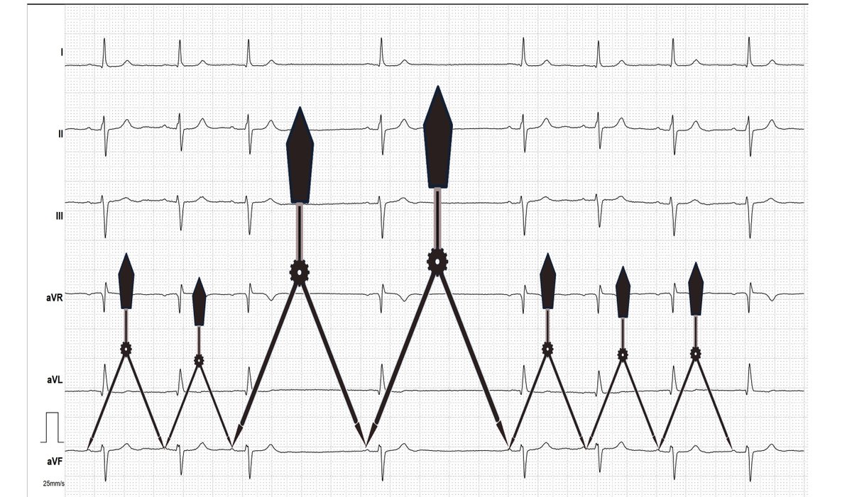 Answer: most probably pronounced nonrespiratory sinus arrhythmia; i think it is not an SA block 👇