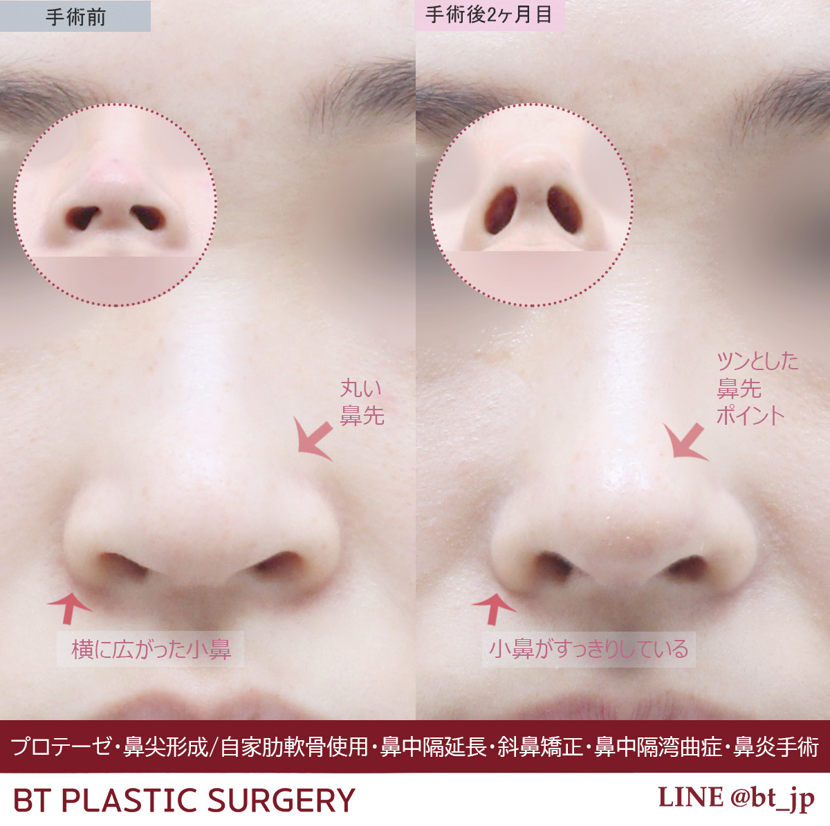 輪郭と鼻整形専門」 #BT整形外科 💬 公式LINE https://t.co/KVQmQjK1wl 🧑\u200d⚕️耳鼻科専門医《イ・スンホ院長 》  ✓プロテーゼ隆鼻術 ✓鼻尖形成・自家肋軟骨使用 ✓鼻中隔延長 ✓斜鼻矯正 ✓鼻中隔湾曲症 ✓鼻炎手術 丸くて広がっていた鼻が  ツンとした派手ながら自然な ..., image size:1200x1194