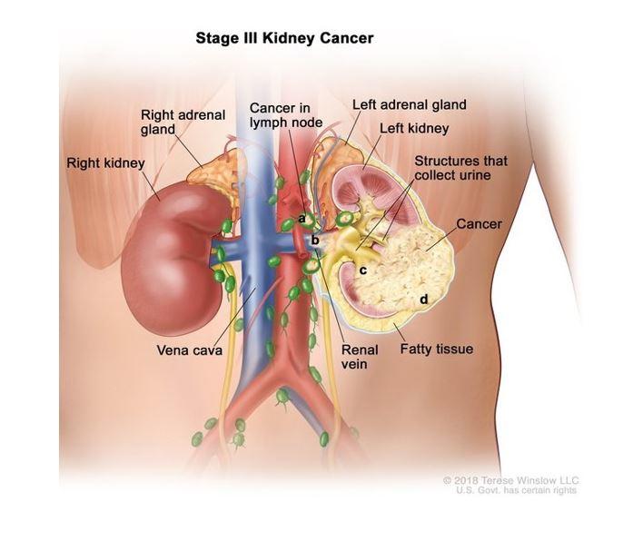 🔘 Pembrolizumab Provides First-Ever Overall Survival Improvement in Kidney Cancer

#kidneyCancer #Immunotherapy @theNCI @DrChoueiri 

cancer.gov/news-events/ca…