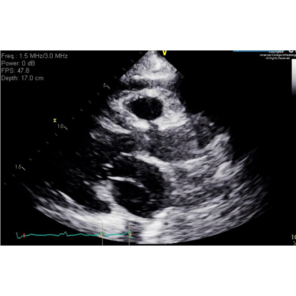 A 66-year-old woman with a history of coronary artery disease presents with palpitations and dizziness. #ACRCaseinPoint bit.ly/3UzFety