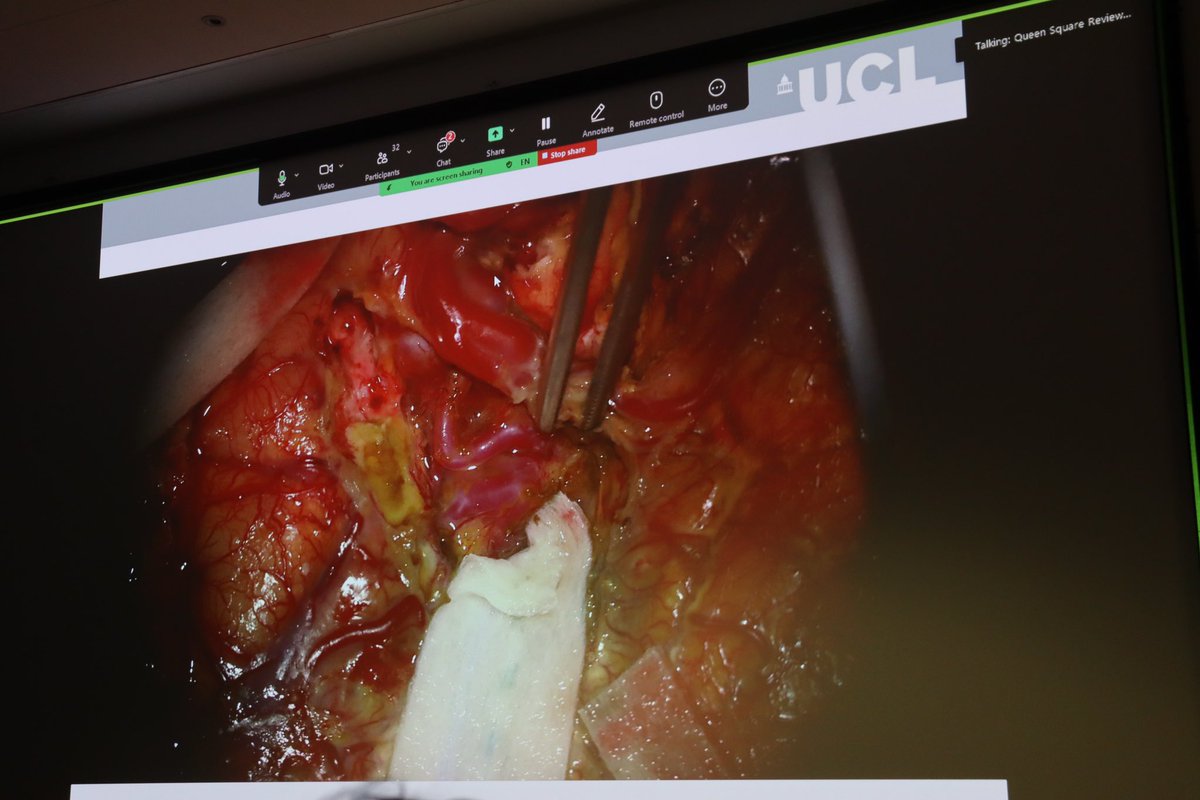 Queen Square Neurosurgery Review Course (@qsreview) on Twitter photo A pleasure to welcome <a href="/DulankaSilva/">Dulanka Silva</a> back to talk about paediatric neuro-vascular surgery, with a focus on moya moya disease and AVMs 🧶 A pleasure to welcome <a href="/DulankaSilva/">Dulanka Silva</a> back to talk about paediatric neuro-vascular surgery, with a focus on moya moya disease and AVMs 🧶