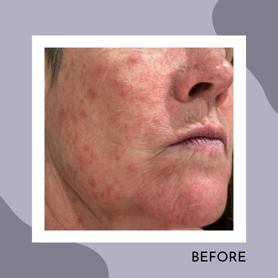 NaturallyTiwa's tweet photo. Transform your skin with #MIMOSkincare! 🌟
Swipe for #BeforeAndAfters! ➡️
Try our Cleansing Balm & Facial Serum for a #RadiantGlow.
Perfect for #AllSkinTypes, including #AgeingSkin and healing skin impacted by #Cancer treatments.
👋 Tag a friend in need of a skin solution! https://t.co/BCCColvz8f