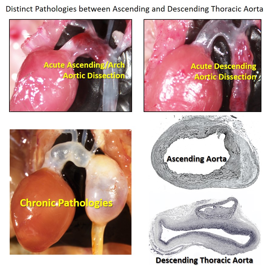 β-Aminopropionitrile Induces Distinct Pathologies in the Ascending and Descending Thoracic Aortic Regions of Mice | Arteriosclerosis, Thrombosis, and Vascular Biology ahajournals.org/doi/10.1161/AT…