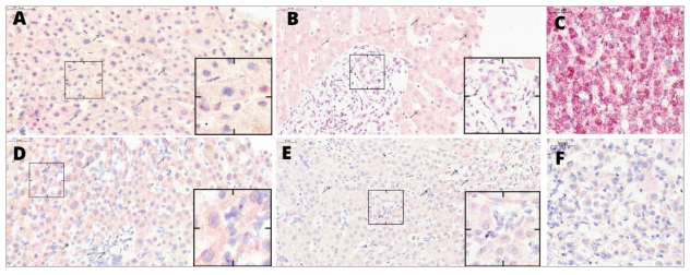 DgPratas's tweet photo. 🚨 New study alert! 🚨 Insights on inherited chromosomally integrated HHV-6B in liver transplants. Essential read for transplant professionals! 🧬🦠

🔗 https://t.co/2lENSlxKFo 

#Transplantation #Virology #HHV6 #MedicalResearch #HealthcareSecurity https://t.co/rzL1IkChw4