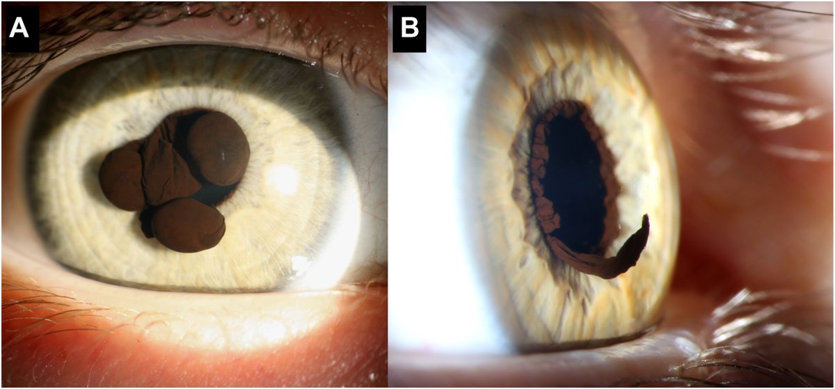 A young woman with congenital pigmented cysts in the pupillary margins, consistent with iris floculli. @GStalhammar ow.ly/9Mbg50RqH1h