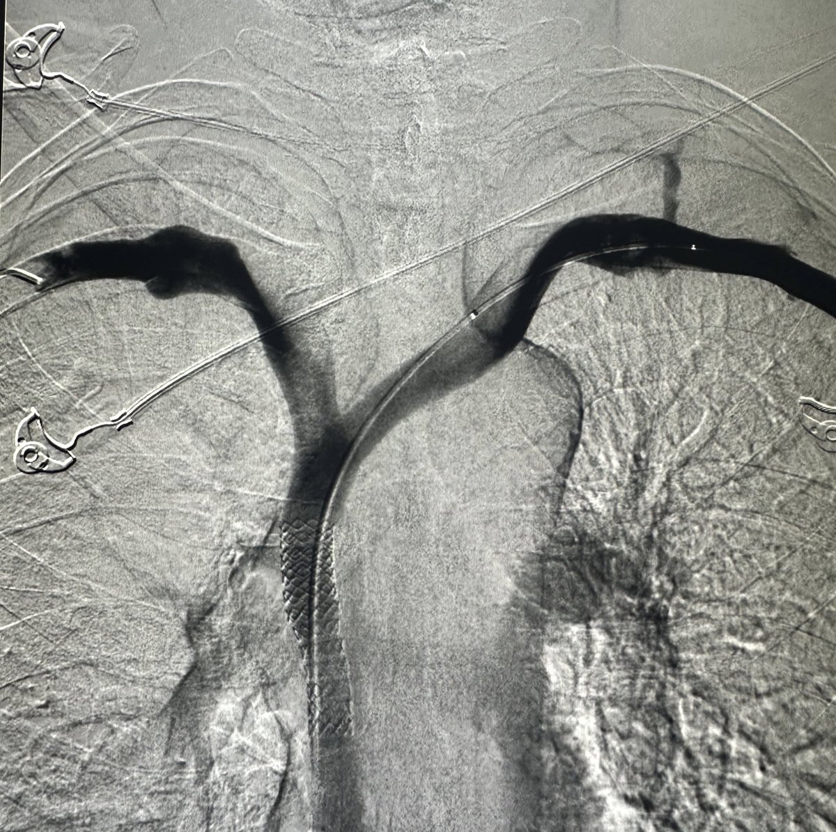 Interventional allergist? Chronic sinusitis was actually lung cancer obstructing the SVC pooling venous blood in the face, neck and chest. Restoring natural flow significantly improved this pts symptoms. @ChengaziMD @SIRRFS @SIR_ECS @SIRspecialists #irad #vascular #medtwitter