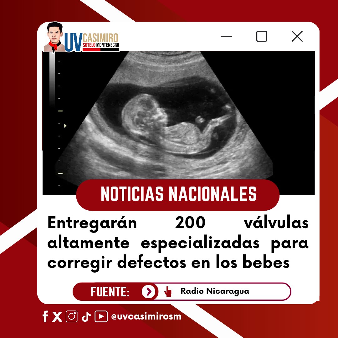 En #Nicaragua gracias a nuestro Buen Gobierno Sandinista estarán entregando 200 válvulas para corregir defectos de los bebes para que nazcan sanos.
#4519LaPatriaLaRevolución
#ManaguaSandinista
#SoyCSM seguimos #EnDefensaDelFSLN ✌️🔴⚫✊