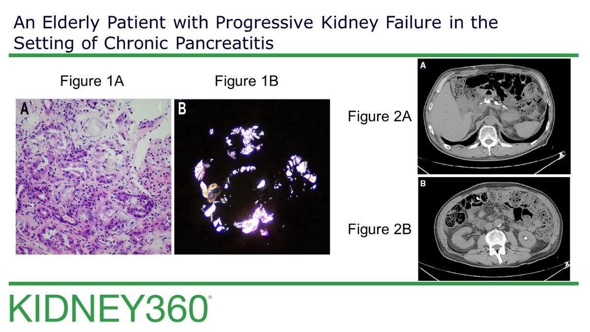 New: Clinical Images in Nephrology & Dialysis These cases feature progressive kidney failure with chronic pancreatitis & partial recovery of kidney function in a patient with sepsis-associated oliguric AKI. Can you guess the correct diagnoses? journals.lww.com/Kidney360/Page…
