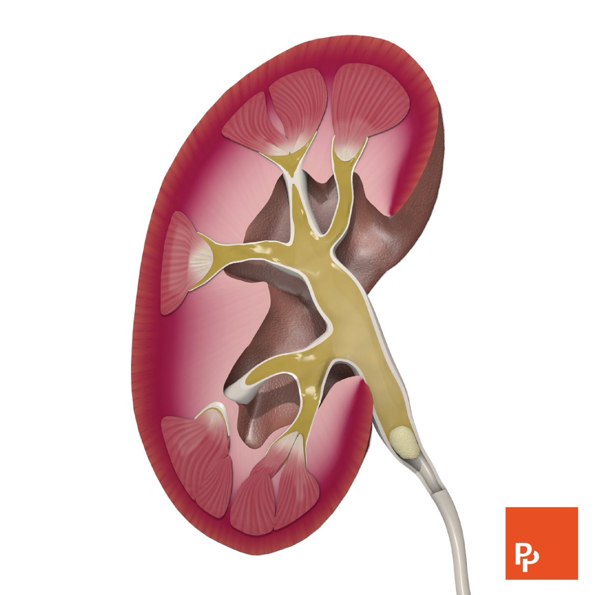 Kidney stones are hard deposits made of minerals and salts formed in the kidneys when substances in the urine, such as calcium and uric acid, turn into crystals.

#anatomy #physiology #kidneyhealth #kidneystones