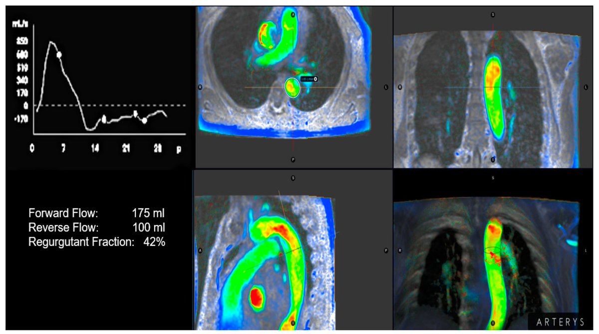 🔴Aortic Regurgitation: From Valvular to Myocardial Dysfunction #OpenAccess #2024Review 

mdpi.com/2077-0383/13/1…
 #medicine #cardiology #medical #medx #cardiotwiteros #medtwitterWhat #paramedic #MedTwitter #CardioEd #FOAMed #cardiox #medtwitter #cardiotwitter #cardiovascular