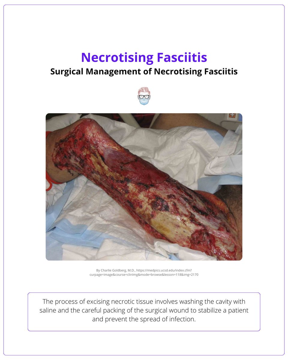 PlasticsFella's tweet photo. #ThreadThursdays
Necrotising fasciitis is a severe, rapidly progressing infection of deep soft tissues, characterized by extensive tissue necrosis. It's rare but carries high risks of morbidity and mortality.
A thread on early recognition and treatment 🧵 https://t.co/UvcsluNhlQ