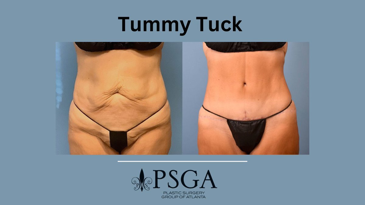 Get summer ready with Plastic Surgery Group of Atlanta. This tummy tuck was performed by Dr. Hart to reduce excess skin after weight loss.

📞 Call 404-348-4456 to see if you’re a candidate.

#TummyTuck #Results #BodyGoals 

plasticsurgerygroupatl.com/procedures/non…