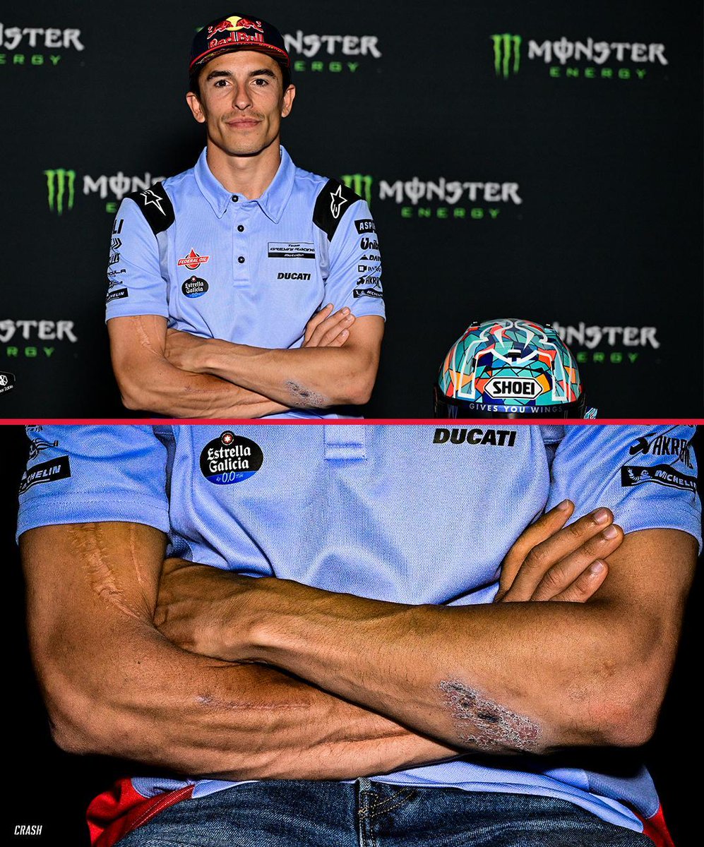 The scars & cuts on Marc Marquez's arms 😲💪 #MotoGP #CatalanGP