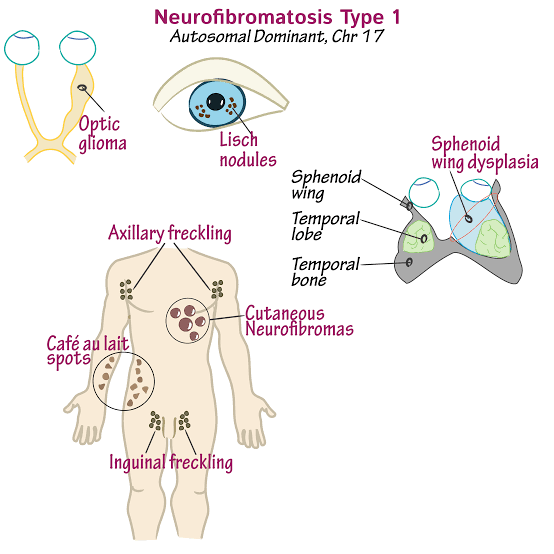 @modernHealthMe Neurofibromatosis type 1 (NF1) is a multisystem genetic disorder that is characterized by cutaneous findings, most notably café-au-lait spots and axillary freckling , by skeletal dysplasias, and by the growth of both benign and malignant nervous system tumors, most notably benign