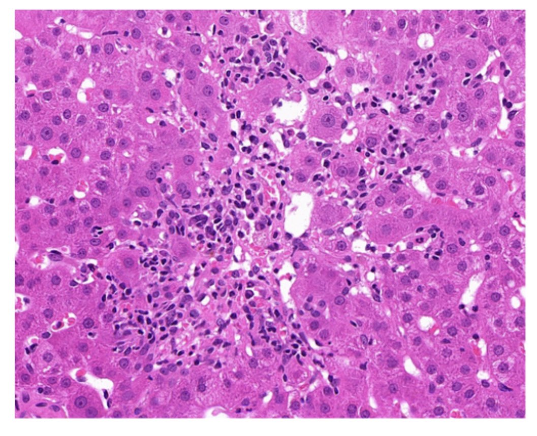 Dina Tiniakos (@dinatiniakos) on Twitter photo Want to know more on severe acute liver injury? Freshly published overview by the Gnomes🔺 on the contemporary role of #liver biopsy 🩼in diagnosis 🔬🧬 <a href="/Histo_Journal/">Histopathology</a> <a href="/ESP_Pathology/">European Society of Pathology (ESP)</a> <a href="/EASLnews/">EASLnews</a> <a href="/my_ueg/">my_UEG</a> <a href="/LiverPath_HPHS/">Hans Popper Hepatopathology Society</a> <a href="/UKLiverPath/">UK Liver Pathology Group</a> <a href="/AASLDtweets/">AASLD</a> <a href="/EASLedu/">EASL Education</a>
onlinelibrary.wiley.com/doi/epdf/10.11… Want to know more on severe acute liver injury? Freshly published overview by the Gnomes🔺 on the contemporary role of #liver biopsy 🩼in diagnosis 🔬🧬 <a href="/Histo_Journal/">Histopathology</a> <a href="/ESP_Pathology/">European Society of Pathology (ESP)</a> <a href="/EASLnews/">EASLnews</a> <a href="/my_ueg/">my_UEG</a> <a href="/LiverPath_HPHS/">Hans Popper Hepatopathology Society</a> <a href="/UKLiverPath/">UK Liver Pathology Group</a> <a href="/AASLDtweets/">AASLD</a> <a href="/EASLedu/">EASL Education</a>
onlinelibrary.wiley.com/doi/epdf/10.11…