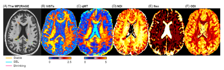 Longitudinal myelin content measures of slowly expanding lesions using 7T MRI in multiple sclerosis onlinelibrary.wiley.com/doi/epdf/10.11… #neuroimaging #neurology #neurotwitter #neuroscience #neurorad #radres @WileyNeurology @asneuroimaging #multiplesclerosis #7TMRI #myelin Free to read