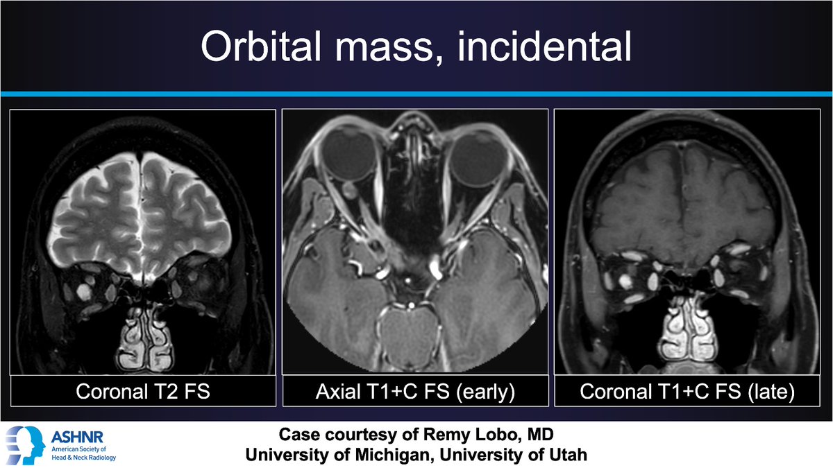 ASHNR (@ashnrsociety) on Twitter photo #ASHNRCOTW #254: Orbital mass. Thx
<a href="/remyrlobo/">Remy Lobo</a> 4 case! #ASHNR24
Answer w/ appropriate GIF only -- stay professional & don't spoil it!
<a href="/callyrobs/">Caroline Robson, MBChB</a> <a href="/DShatzkes/">Deborah Shatzkes</a> <a href="/CDP_Rad/">C Douglas Phillips 🇺🇸</a> <a href="/rhwiggins/">Richard Wiggins</a> <a href="/nakoontz/">Nicholas Koontz</a> <a href="/KRileyMD/">Kalen Riley</a> <a href="/CMGlastonbury/">Christine M Glastonbury, MD</a> <a href="/cmtomblinson/">Courtney Tomblinson, MD</a> <a href="/tabby_kennedy/">Tabby A. Kennedy, MD</a> <a href="/PhilipRChapman1/">Philip R. Chapman, MD</a>
<a href="/kmmosier/">Kristine Mosier</a> #ASHNRCOTW #254: Orbital mass. Thx
<a href="/remyrlobo/">Remy Lobo</a> 4 case! #ASHNR24
Answer w/ appropriate GIF only -- stay professional & don't spoil it!
<a href="/callyrobs/">Caroline Robson, MBChB</a> <a href="/DShatzkes/">Deborah Shatzkes</a> <a href="/CDP_Rad/">C Douglas Phillips 🇺🇸</a> <a href="/rhwiggins/">Richard Wiggins</a> <a href="/nakoontz/">Nicholas Koontz</a> <a href="/KRileyMD/">Kalen Riley</a> <a href="/CMGlastonbury/">Christine M Glastonbury, MD</a> <a href="/cmtomblinson/">Courtney Tomblinson, MD</a> <a href="/tabby_kennedy/">Tabby A. Kennedy, MD</a> <a href="/PhilipRChapman1/">Philip R. Chapman, MD</a>
<a href="/kmmosier/">Kristine Mosier</a>