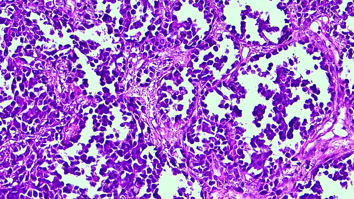 deedee2984's tweet image. Neck Mass; 12yo; It is what it looks like. #HeadandNeckPath #BSTPath #Pedipath @DrGeeONE @JMGardnerMD @DrCycloPath @drlawalm @AishaNabila09 @bjbanji @ariella8 @leon_metlay