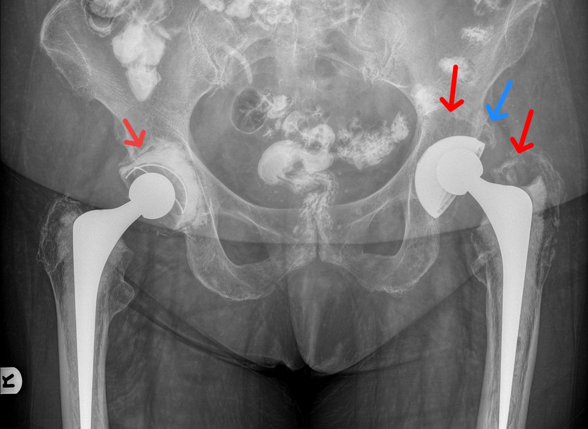 One radiograph a day #1

Periprosthetic lucencies: particle disease causing loosening.
Heterotopic ossification (blue arrow)
Also note asymmetric superior position of left femoral head in acetabular cup indicating polyethylene liner wear.