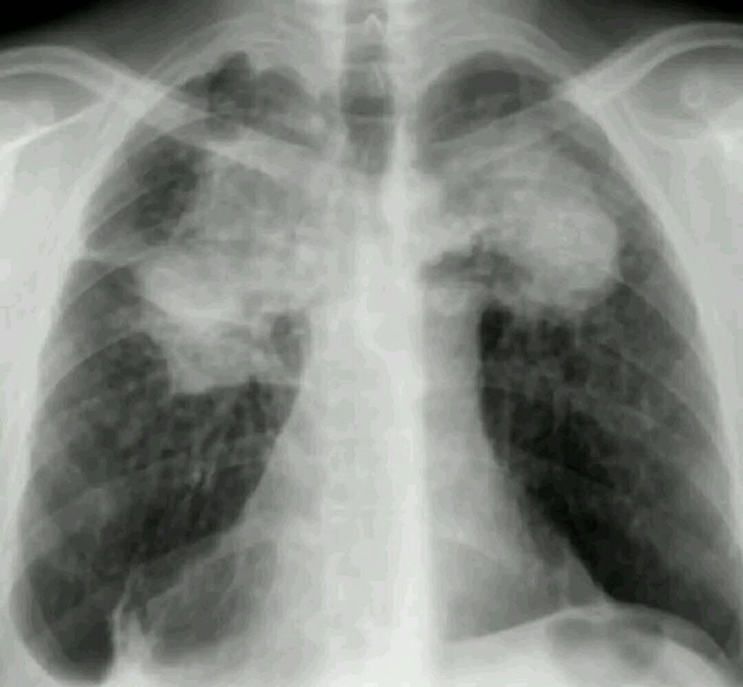 Patient presents with shortness of breath, fatigue, and weight loss. 
Chest X-ray shows this. 
What is your diagnosis?

#MedEd 
#MEDHM 
#MedX 
@IhabFathiSulima
