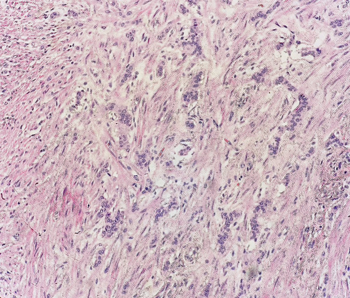 Neuroendocrine Tumor (NET) of Appendix

• 80% are found incidentally after surgery for appendicitis 
• Most common location: tip 
• Not always nested architecture: can be trabeculated, in acini,and ribbons 

Pretty subtle in my opinion👇

#pathagonia #path4people #pathx #medx