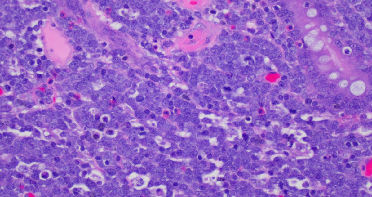 SibaElHussein's tweet image. Illustration of a case of Burkitt lymphoma in the intestine with characteristic variable/ patchy SOX11 expression pattern. SOX11 may come in handy in tricky cases when you need more evidence to push for Burkitt lymphoma vs other mimickers #hemepth #lmsm #pathtwitter #PathX #MedX