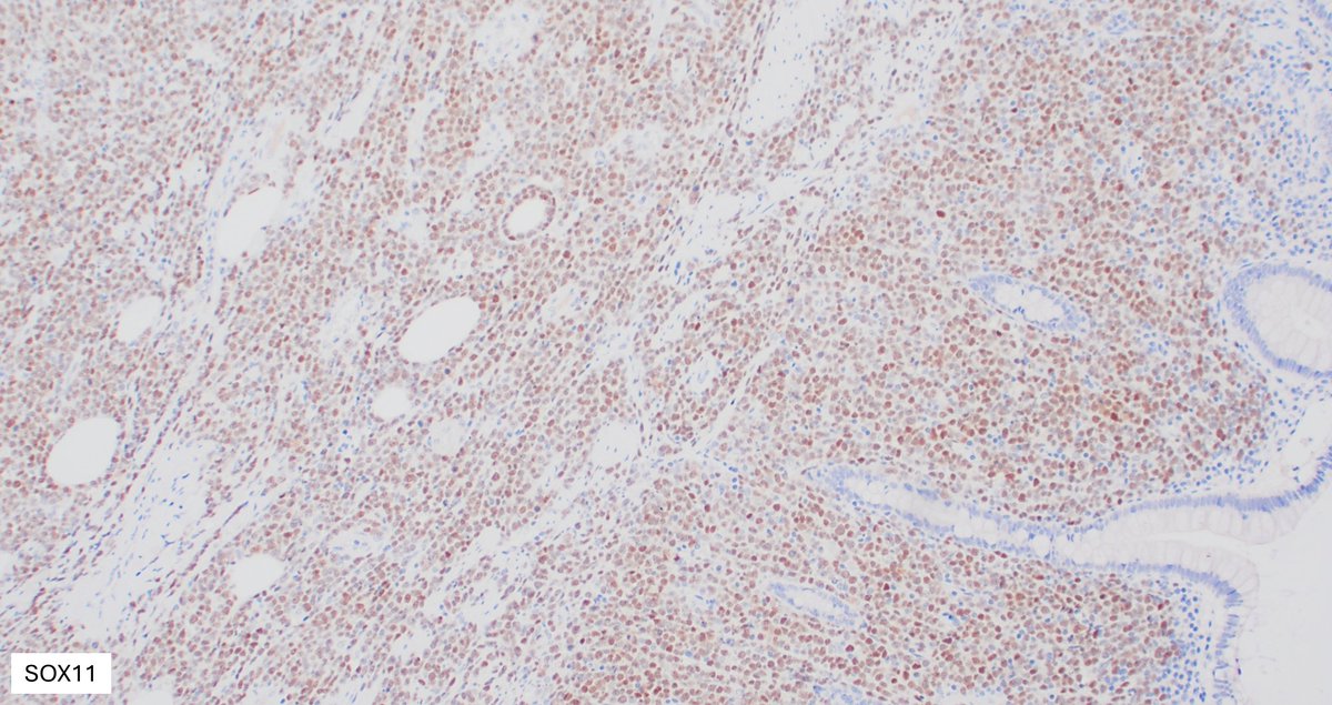 SibaElHussein's tweet image. Illustration of a case of Burkitt lymphoma in the intestine with characteristic variable/ patchy SOX11 expression pattern. SOX11 may come in handy in tricky cases when you need more evidence to push for Burkitt lymphoma vs other mimickers #hemepth #lmsm #pathtwitter #PathX #MedX