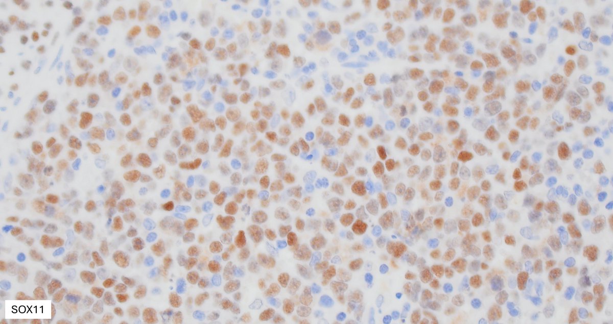 Illustration of a case of Burkitt lymphoma in the intestine with characteristic variable/ patchy SOX11 expression pattern. SOX11 may come in handy in tricky cases when you need more evidence to push for Burkitt lymphoma vs other mimickers #hemepth #lmsm #pathtwitter #PathX #MedX