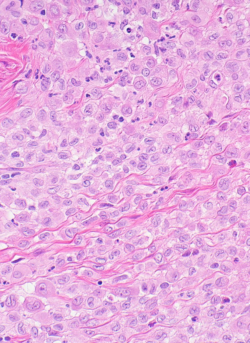 Multiple skin papules in baby. Classic #cytology for what entity?
More pics: kikoxp.com/posts/22380 
Answer ✅ youtu.be/zfuDpaAC9zM?si… 
#pathology #pathologists #pathTwitter #dermpath #dermatology #dermtwitter #pedipath