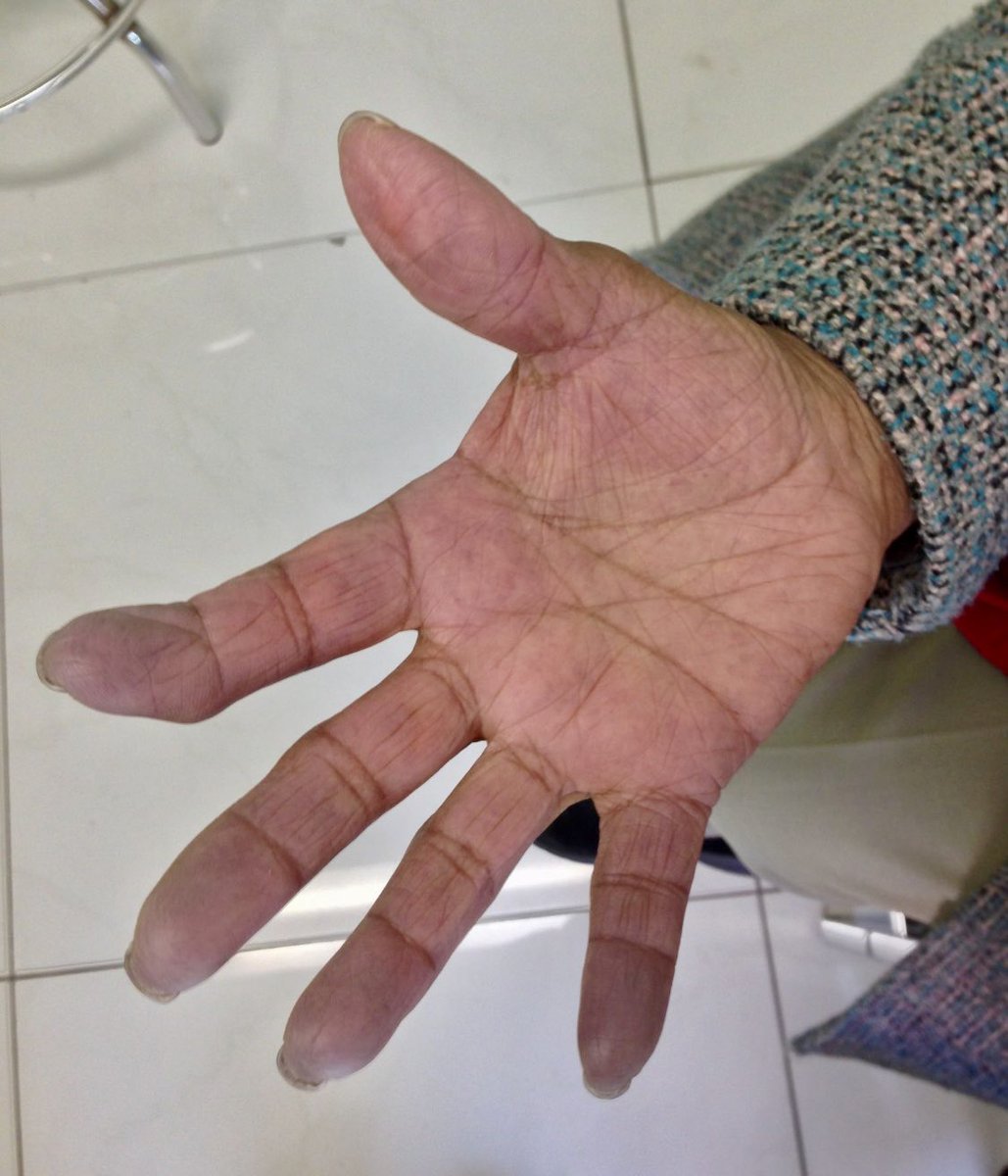 Fenómeno de #Raynaud en paciente con #esclerosis sistémica #MedTwitter #MedEd #ENARM