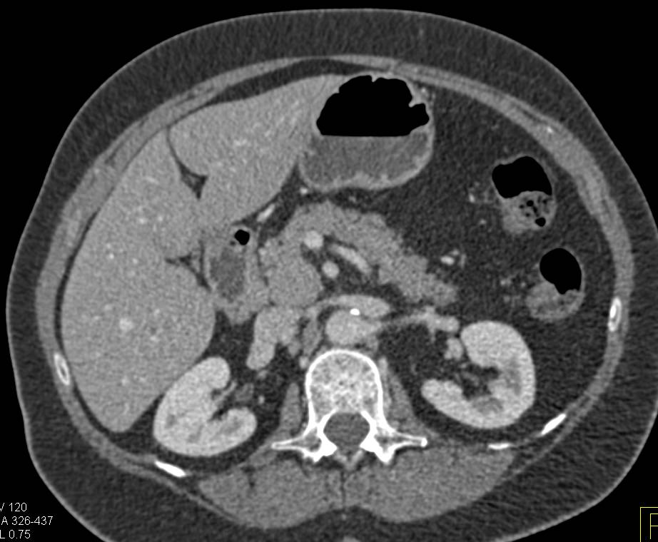 Case 4: what is the dx? Find the answer here: ctisus.com/teachingfiles/…