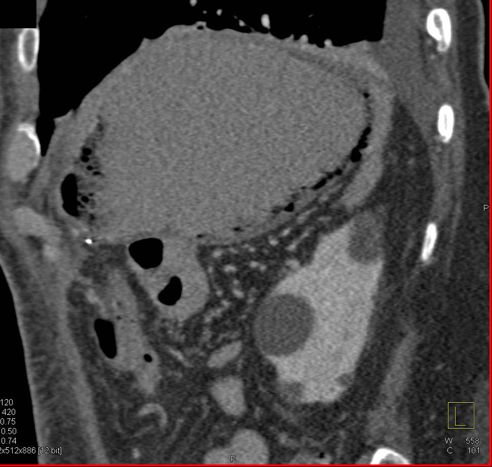 Case 3: what is the dx? The answer is here: ctisus.com/teachingfiles/…