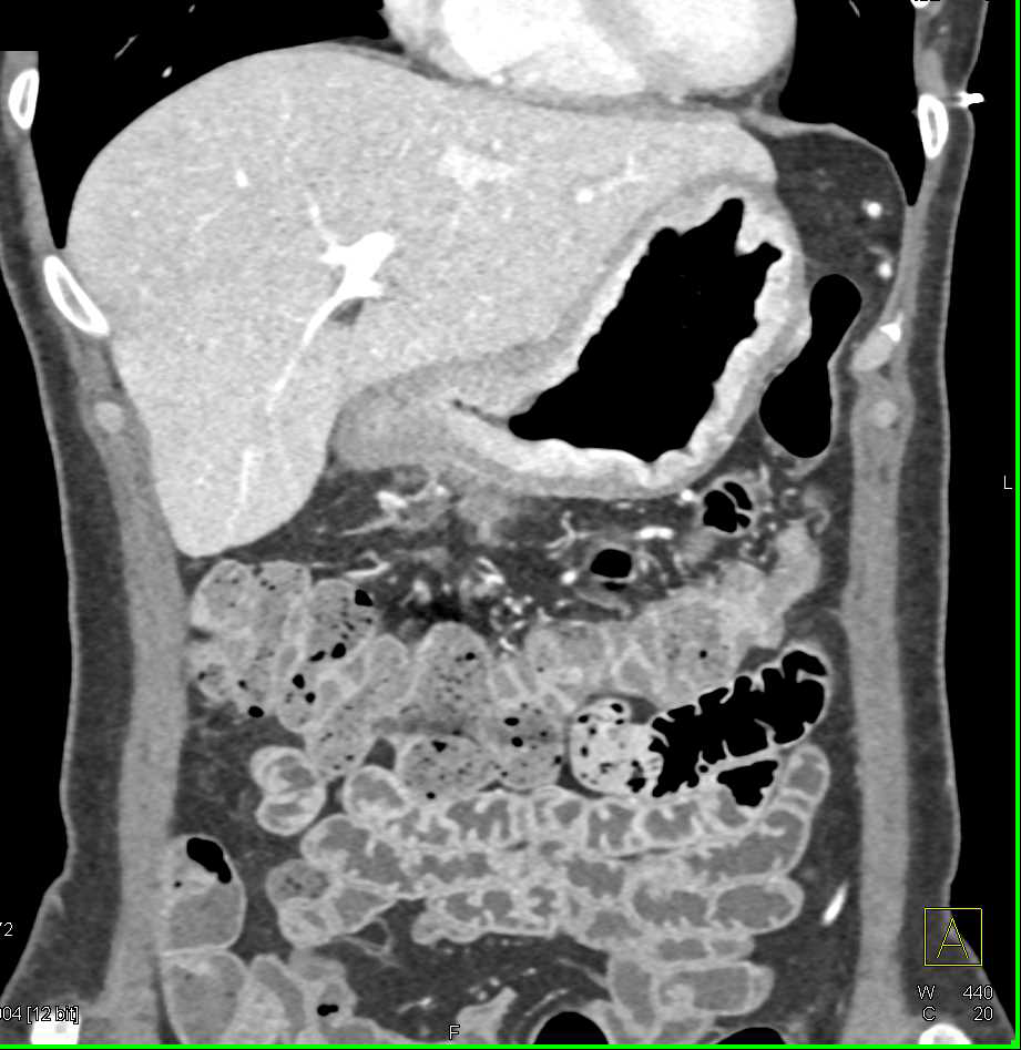 Case 7: what is the dx? Find the answer here: ctisus.com/teachingfiles/…