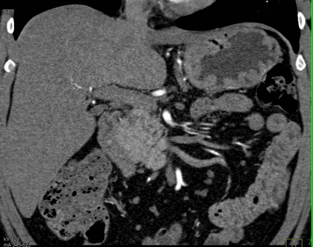 Last case! What is the dx? The answer is here: ctisus.com/teachingfiles/… Thanks for taking out Stomach Quiz today!