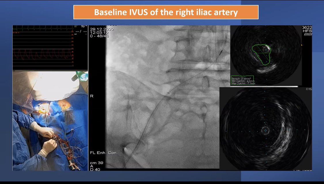 #ThrowbackThursday 🎥 #IVUS guided intervention with zero contrast in a patient with complex bilateral iliac artery disease | @GrigoriosKoros1 @PhilipsHealth @AtulGupta_MD @EricSecemskyMD @farkomd @FadiSaab17 @CLIGlobalNews @CLIfighters @AmputationSuck lnkd.in/eh_KTQ3B