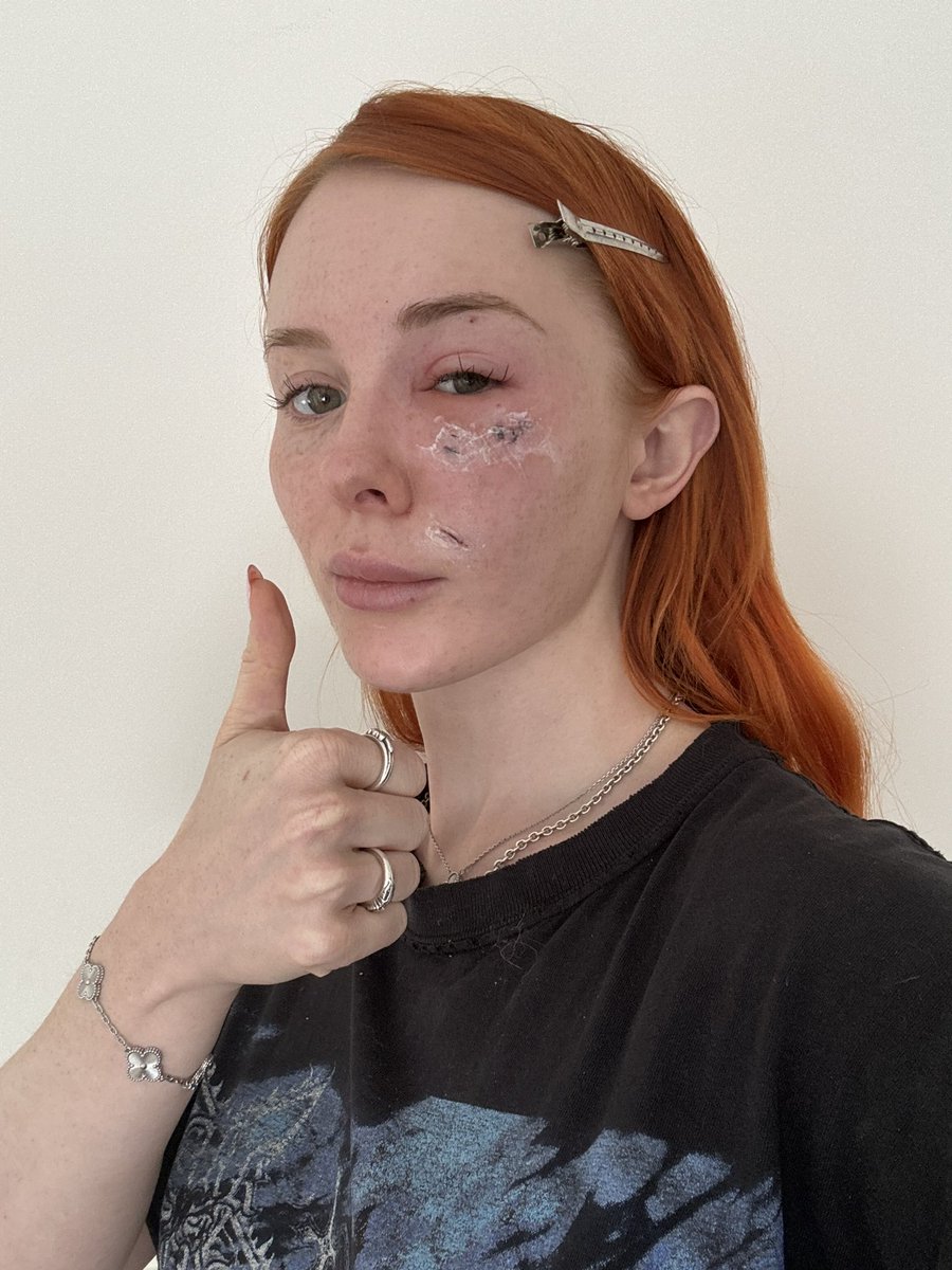 meowri's tweet photo. hi everyone! posting is going to be a little less regular until I heal up. 
I got attacked by a dog the other day and had to get stitches. I’m feeling a bit swollen rn but just figured I’d give you all an update. https://t.co/gjyvoOaZqO